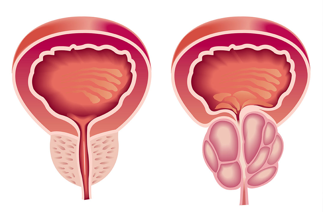 adenome prostate