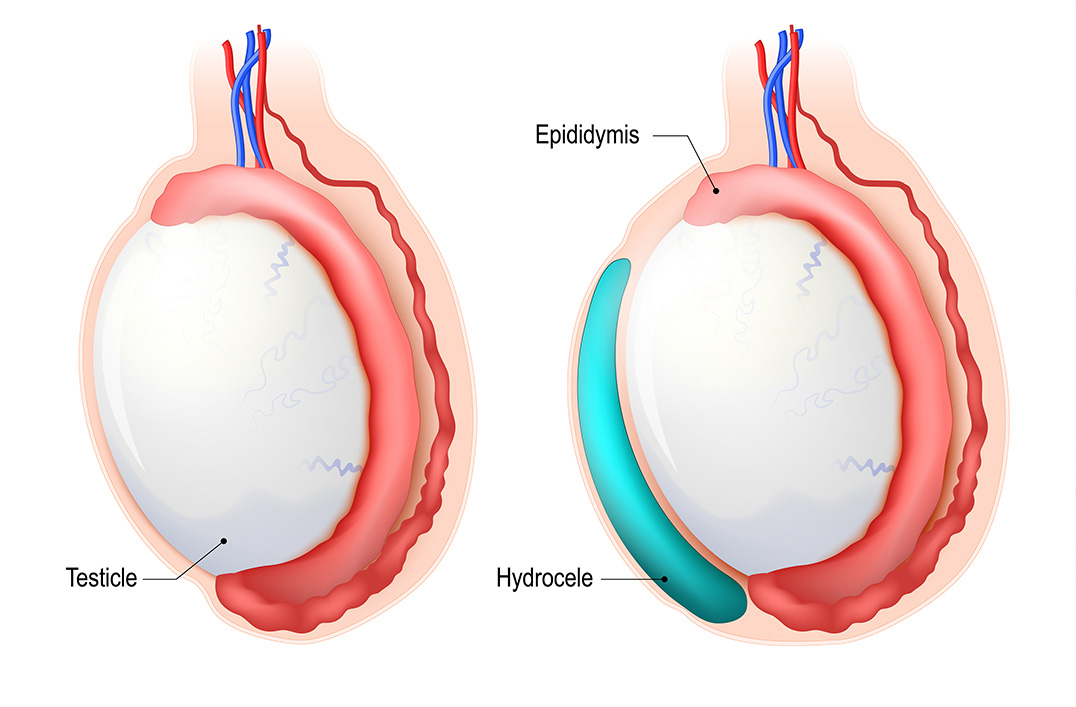 hydrocele testiculaire