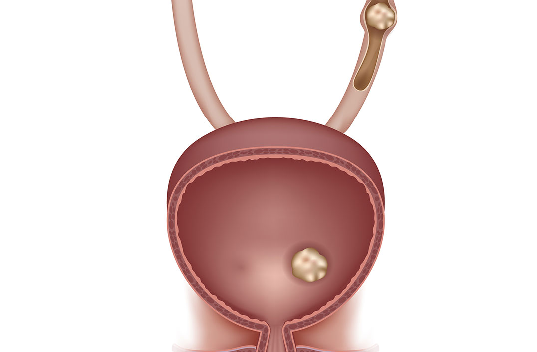 lithiase urinaire