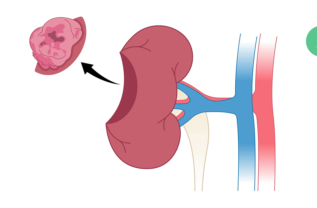 nephrectomie partielle