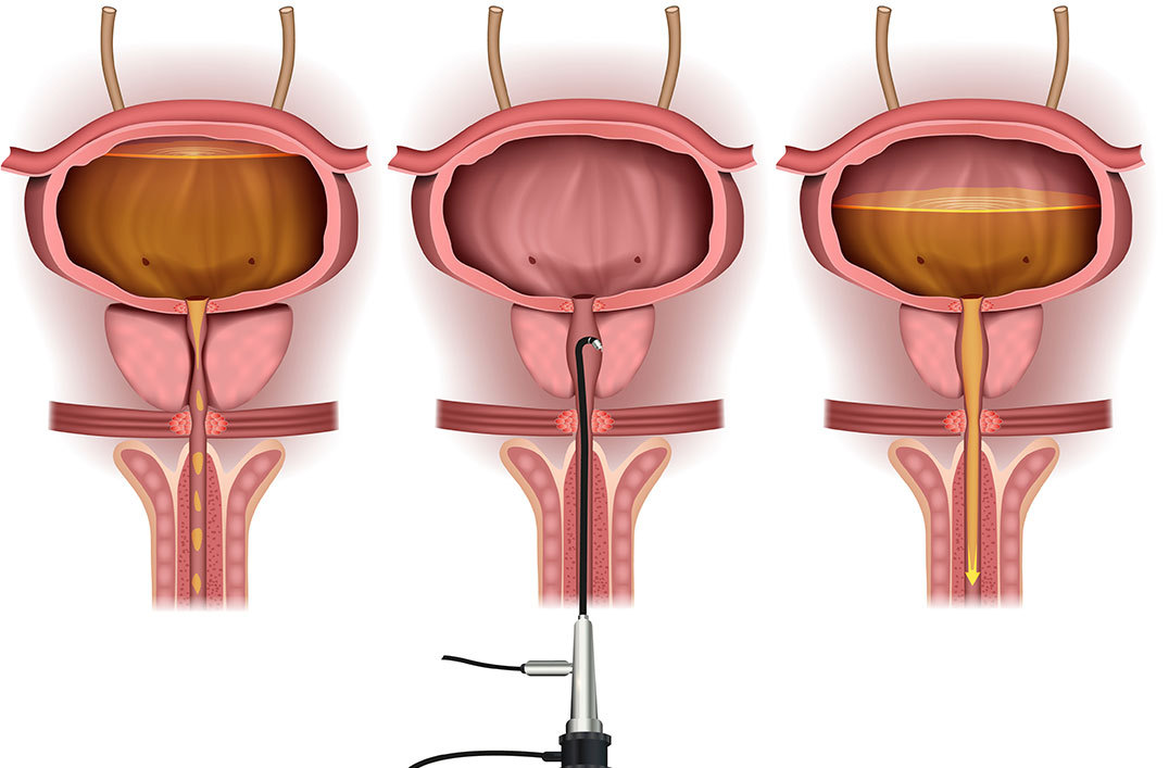 résection endoscopique prostate