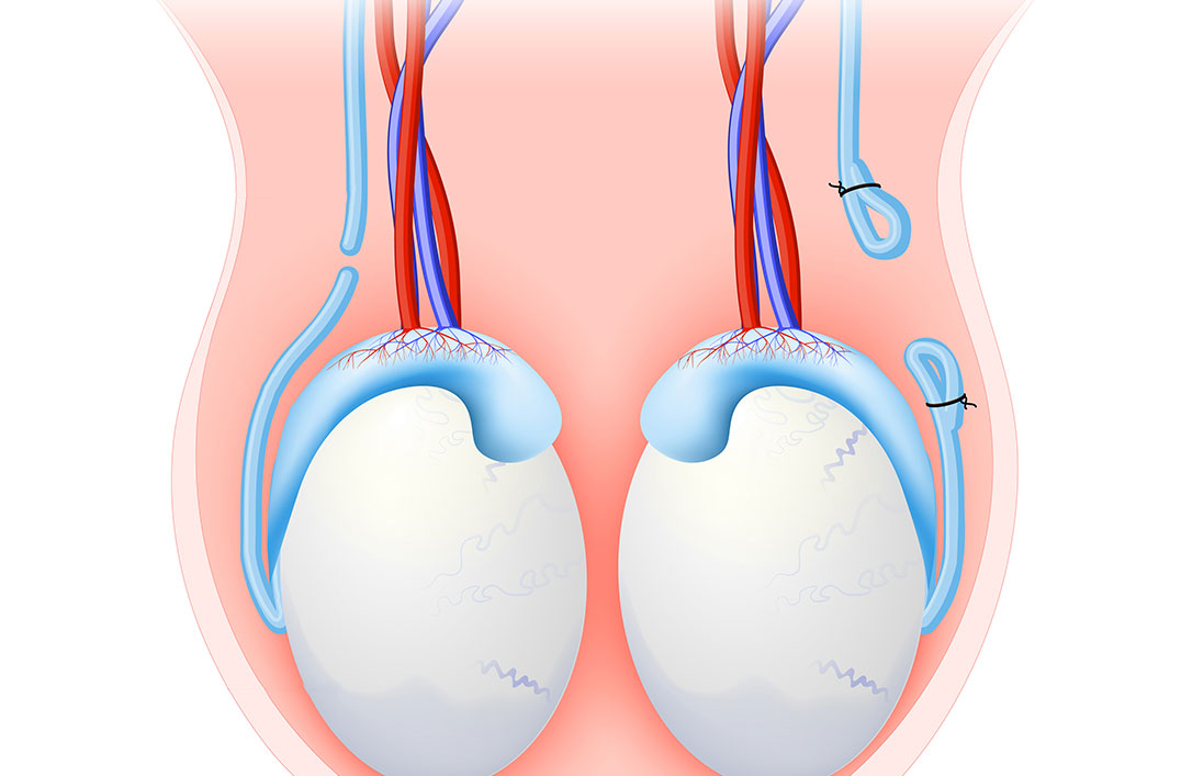 vasectomie